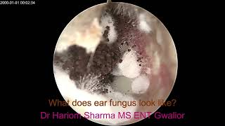 Ear Fungus  Otomycosis [upl. by Aniuqal]