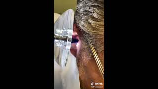 Ear Cleanings with quotDr Wax Busterquot [upl. by Eimac510]