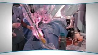 About TransOral Robotic Surgery TORS [upl. by Sheridan]