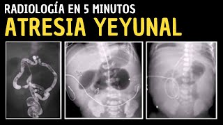 Radiología en 5 minutos Atresia yeyunal [upl. by Alameda148]