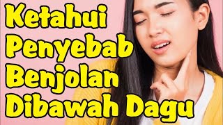 Penyebab Benjolan di Bawah Dagu yang Perlu Diketahui [upl. by Feucht]