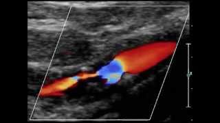 hemodynamic stenosis of the internal carotid artery [upl. by Yadrahs]