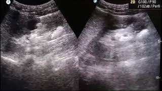 KIDNEY STONES  show multiple calculi  ultrasound usg stone kidney calculi [upl. by Esihcoc]