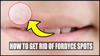 SYRINGOMA VS FORDYCE SPOTS  NATURAL REMEDIES [upl. by Orran994]