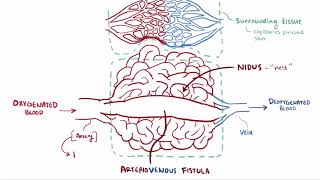 Arteriovenous malformation AVM causes symptoms diagnosis amp pathology [upl. by Arretal]