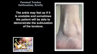 Peroneal Tendon Subluxation Briefly  Everything You Need To Know  Dr Nabil Ebraheim [upl. by Mahseh]