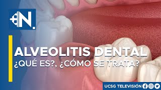 Alveolitis dental ¿Qué es y cómo se trata l Lo mejor del día Viva Mejor TV [upl. by Neiman]