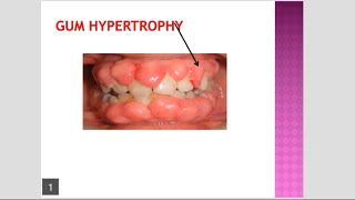 Gum Hypertrophy Gum Hyperplasia due to Phenytoin Amlodipine and Cyclosporine [upl. by Einwahr470]