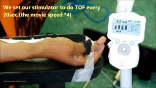 3Neuromuscular monitoring TOF for induction [upl. by Nyleimaj]