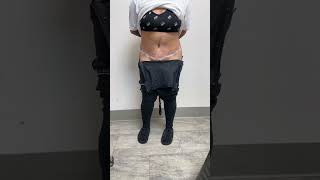 1 DAY AFTER A TUMMY TUCK BY DR GABRIEL PATINO 05 09 20245105257999 [upl. by Wasserman49]