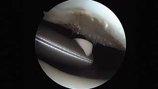 Arthroscopic Chondral Debridement Using Radiofrequency [upl. by Adlemy]