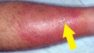 5 Effective and Easy Home Remedies for Cellulitis [upl. by Pet55]