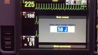 Cardioversión sincronizada en paciente real con Taquicardia Supra Ventricular [upl. by Ecnaret]