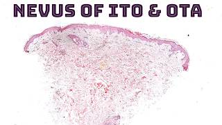 Nevus of Ito Ota Sun Hori amp Dermal Melanocytosis quotMongolian Spotquot under the microscope dermpath [upl. by Boleyn]