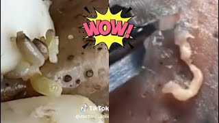 Ultimate Pimple Popping Compilation  Extreme Acne Treatment  Satisfying Blackhead Removal [upl. by Ellissa644]