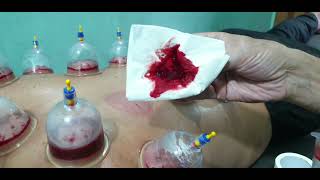 Ababeel Hijama Ghar Nanhe Khan Gali Panchaiti Akhara Gaya  78703 73133  Cupping Therapy  Detox [upl. by Acul]