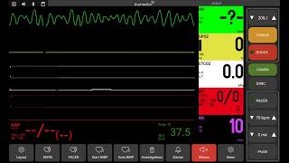 Ventricular fibrillation [upl. by Hengel]