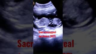 Sacrococcygeal teratoma SCT [upl. by Jit746]