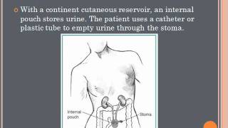 Urinary Diversions Presentation [upl. by Scutt]