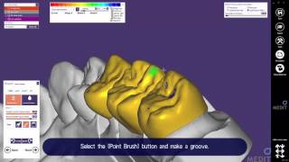 exocad 3unit with virtual articulator en [upl. by Candice738]