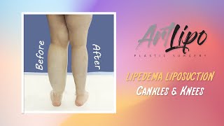 Lipedema Leg Transformation  Cankles amp Knees Complex   Lipo 360°  Expert Dr Thomas Su [upl. by Guillermo]