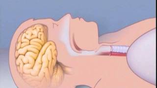 What Is Sleep Apnea [upl. by Lambert353]