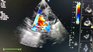 Tricuspid Valve atresia with D transposition [upl. by Preuss]