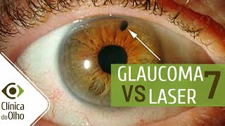 Glaucoma X Laser parte 7  Como a Iridotomia pode afetar um sintoma do glaucoma [upl. by Ecyla]