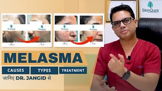 All About Melasma  Causes Types and Treatment options  जानिए Dr Jangid से हिंदी में  SkinQure [upl. by Smitt]