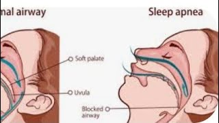 sleep Apnea surgery medicalstudent [upl. by Brietta]