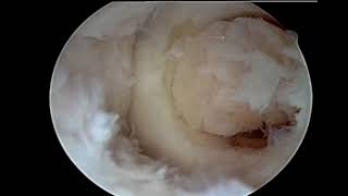 OATs Autograft Cartilage Transplantation [upl. by Armand]