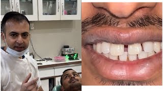 Mid line diastema  teeth gap closure दातों के बीच के गेप्स को भरना [upl. by Darce]