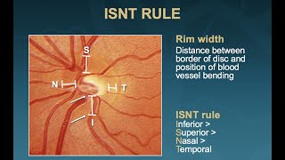 The 5 Rs of Examining the Optic Disc Malik Y Kahook MD [upl. by Newmark]