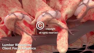 Lumbar Rhizotomy Animation [upl. by Fennelly347]