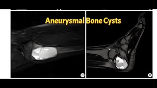 Aneurysmal Bone Cyst  The Bone Thats Alive [upl. by Katharine]