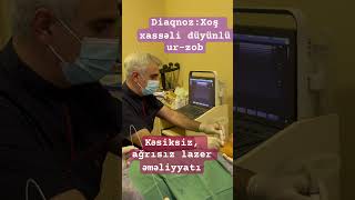 Laser ablation of thyroid nodules tiroid düyünündə lazer əməliyyatı [upl. by Reimer933]