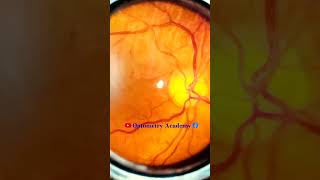 Normal fundus  Normal Retina  Smartphone Fundus Videography  Fundus Photography  Short Video 91 [upl. by Neiluj]