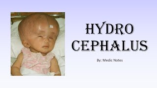 Hydrocephalus  types causes signs and symptoms investigation treatment [upl. by Ardnasac]