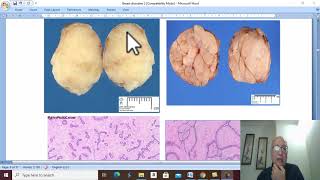 Breast Disorders in Arabic 16  Fibroadenoma  by Dr Wahdan [upl. by Arej]