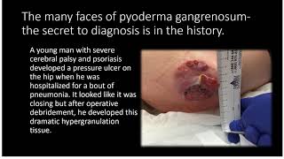 Faces of Pyoderma Gangrenosum [upl. by Brenton]