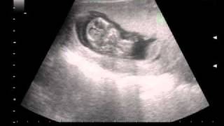 pregnancy ultrasound second month [upl. by Jones540]