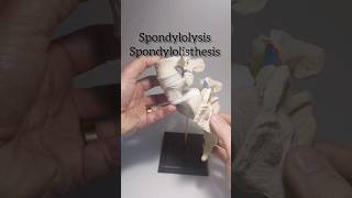 Spondylolysis Spondylolisthesis Dynamic Disc Designs Model [upl. by Arymat]