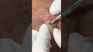 Remove ACNE FAST With These Treatment Secrets dermatologia acne blackheads doctor pimple [upl. by Yslehc118]