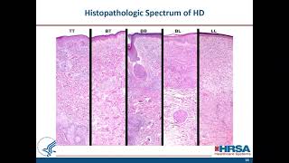 When to Suspect Leprosy Clinical Aspects and Treatment of Uncomplicated Hansens Disease [upl. by Enomys780]