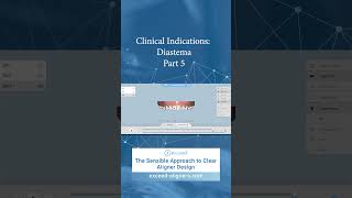 Clinical Indications Diastema Part 5 [upl. by Netsoj804]