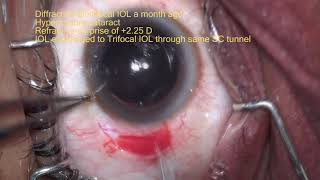 IOL exchange Scleral tunnel are the best [upl. by Dreda]