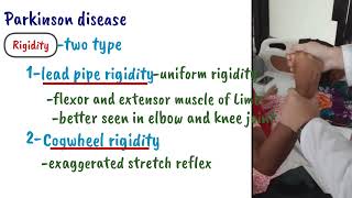 Parkinsons Disease  Clinical Features [upl. by Chase]