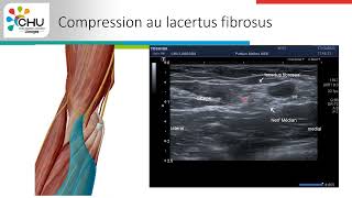 Compression du nerf médian au coude un cas clinique atypique [upl. by Hentrich]