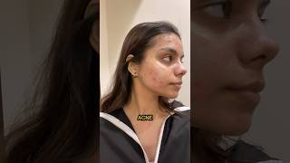 Laser treatment for Acne Scars ‼️ is it worth it Check description for details youtubeshorts [upl. by Arihas]