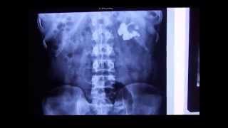 Intravenous Pyelogram  Intravenous Nephrogram  Intravenous Pyelography IVP in Staghorn Calculus [upl. by Attelrahc]